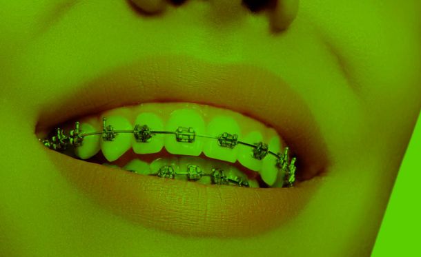 Tratamiento ortodoncia brackets jerez